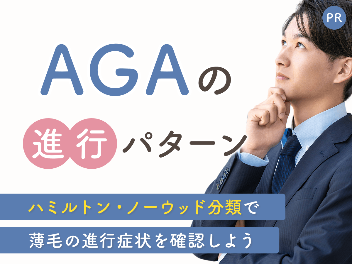 AGAの進行パターンはハミルトン・ノーウッド分類で症状を確認する方法