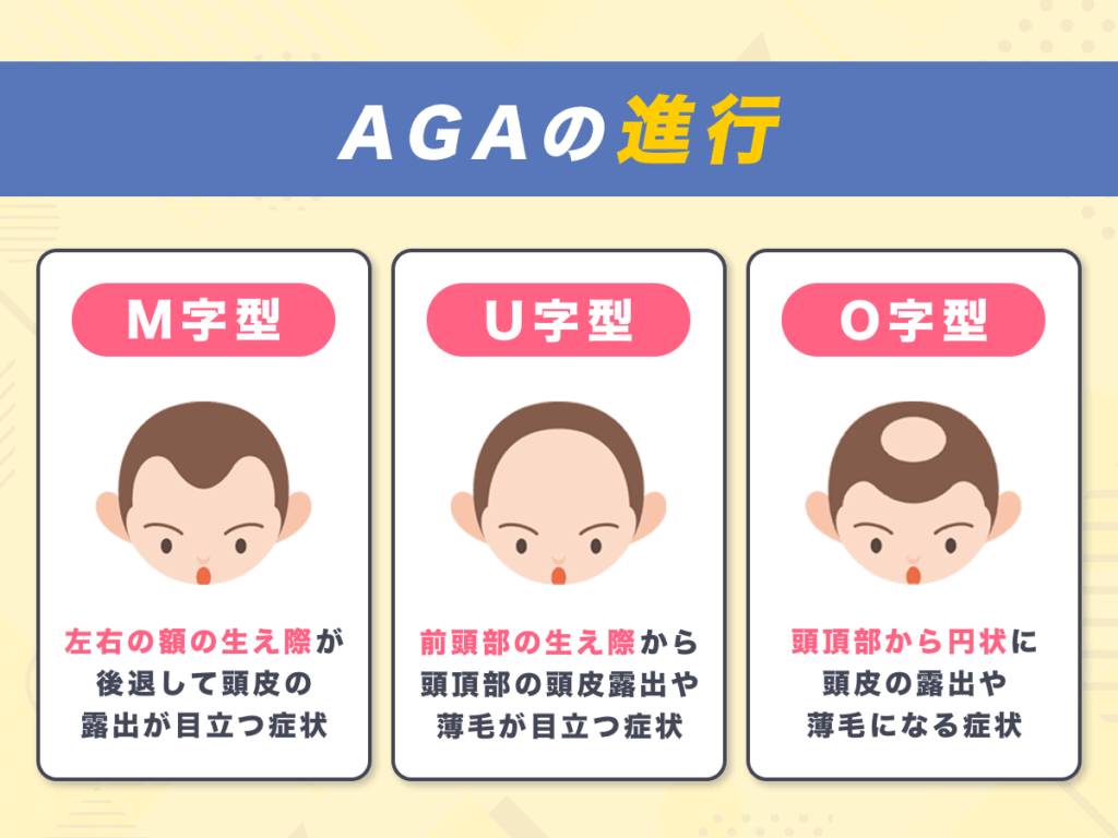 AGAが進行する症状・頭皮の状況